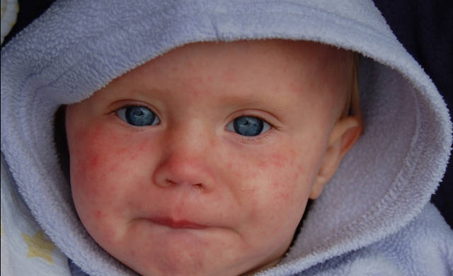 Baby with measles: