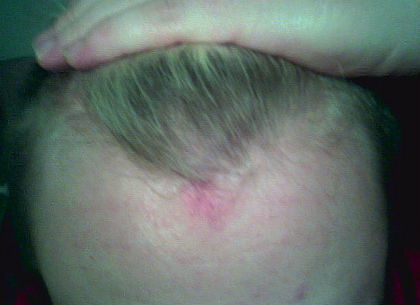 Head bruise: