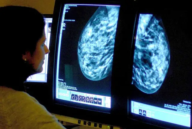 breast cancer screens