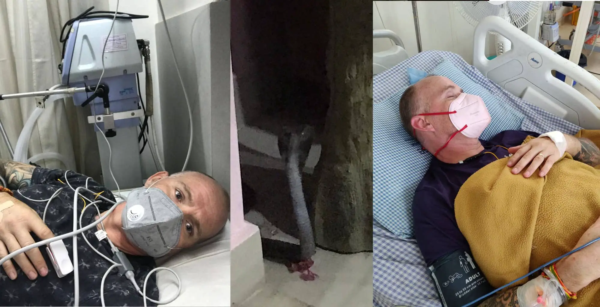 Ian Jones in hospital in India and the King Cobra that bit him
