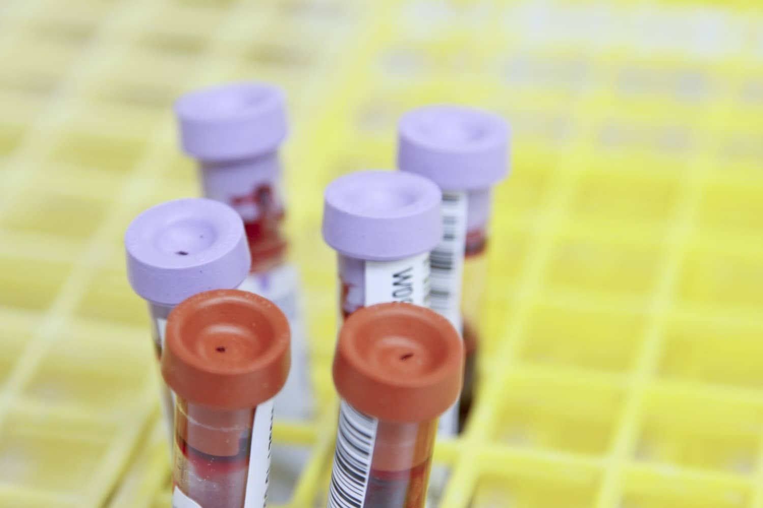 Isle Of Wight NHS Trust Reduce Blood Testing Due To National Shortage Isle Of Wight NHS Trust Reduce Blood Testing Due To National Shortage