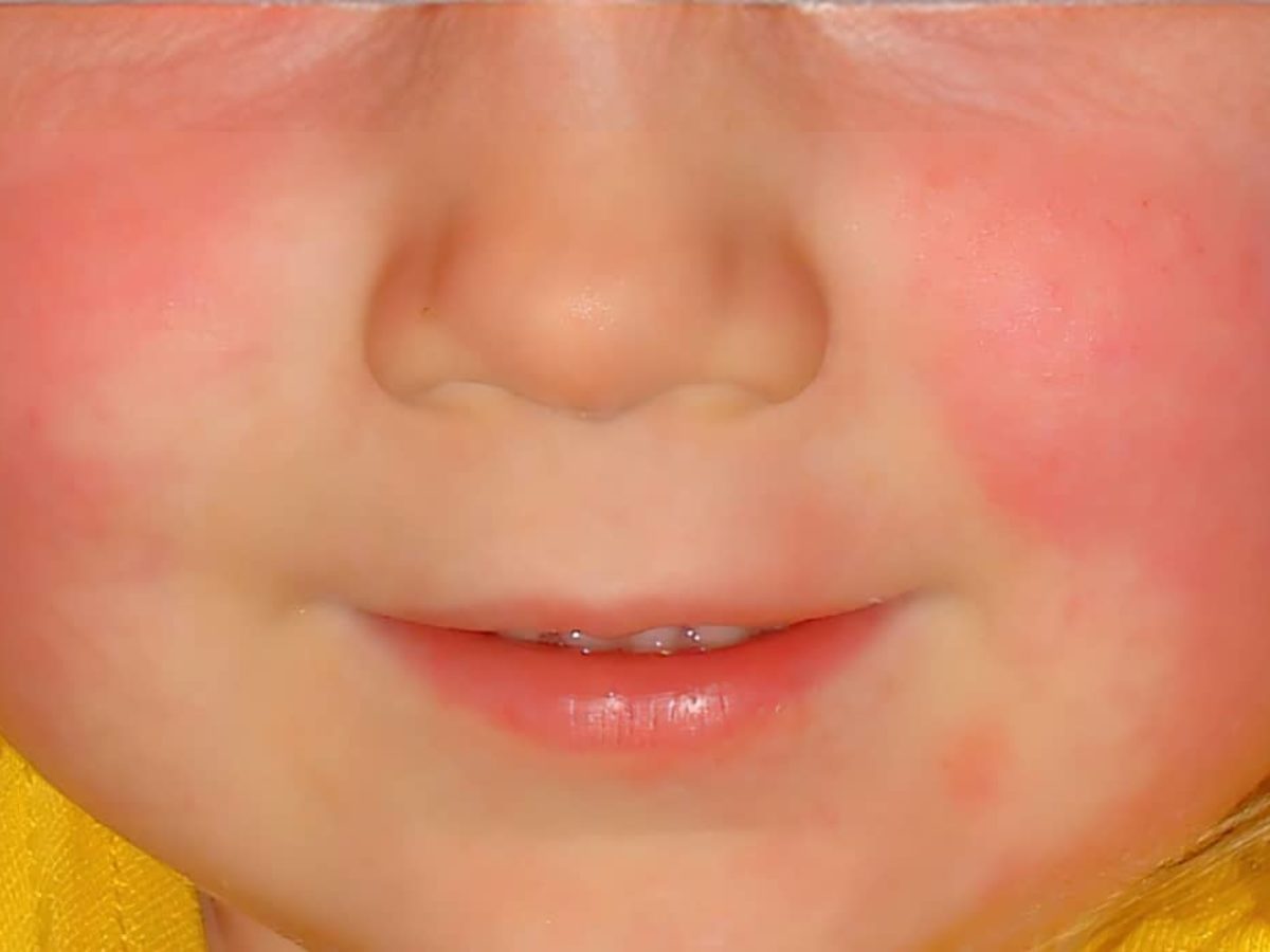 Scarlet Fever: All You Need to Know
