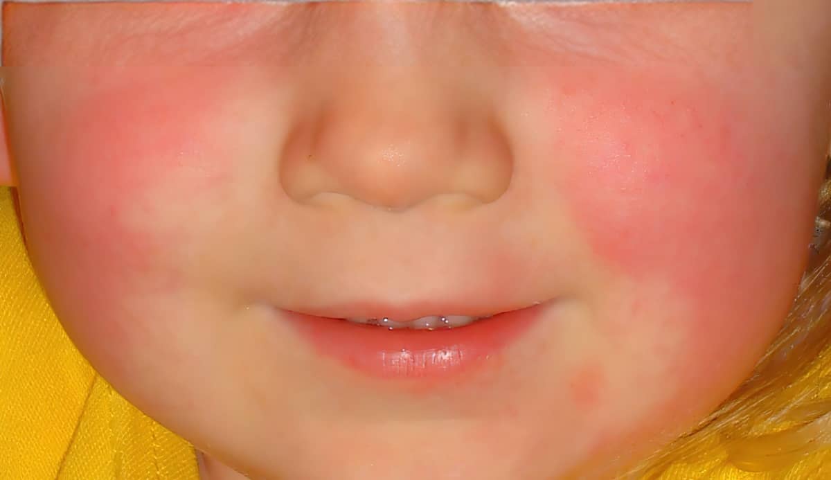 Blushed face of Child with scarlet fever