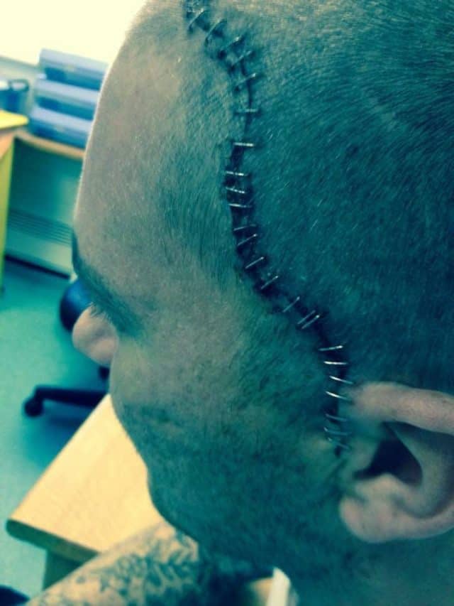 Shaun had 62 staples across his head