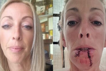 Before and after photos of Lauren Chandler showing damage to face from dog attack