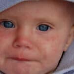 baby with measles